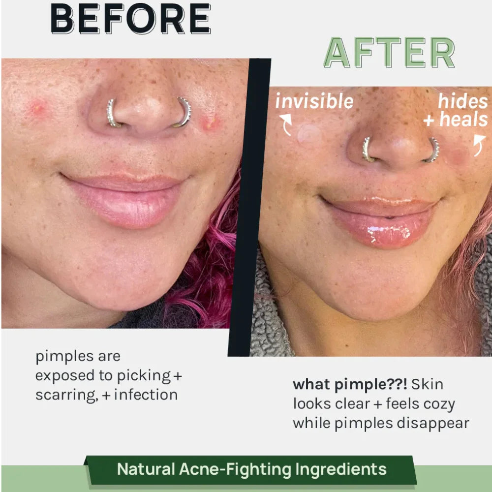 Invisible acne patches on facial skin, before-and-after clearer look