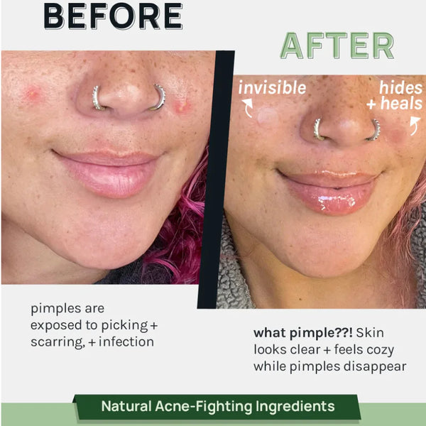 Invisible acne patches on facial skin, before-and-after clearer look