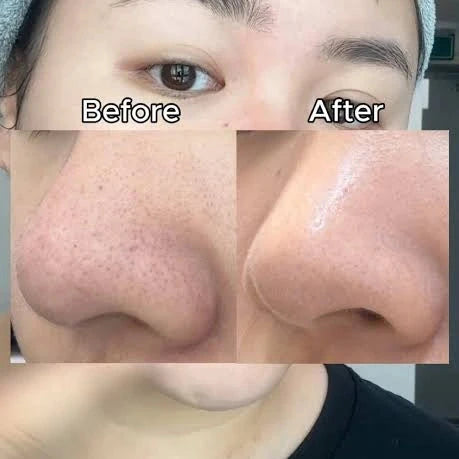 Before and after comparison of a person's nose skin, showing a close-up of the nose with visible pores labeled 'Before' on the left and smoother, clearer skin labeled 'After' on the right. The person is wearing a gray beanie and a black shirt.