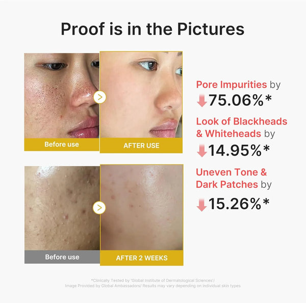 Skin peel shot before-and-after skin close-ups on face, showing complexion changes