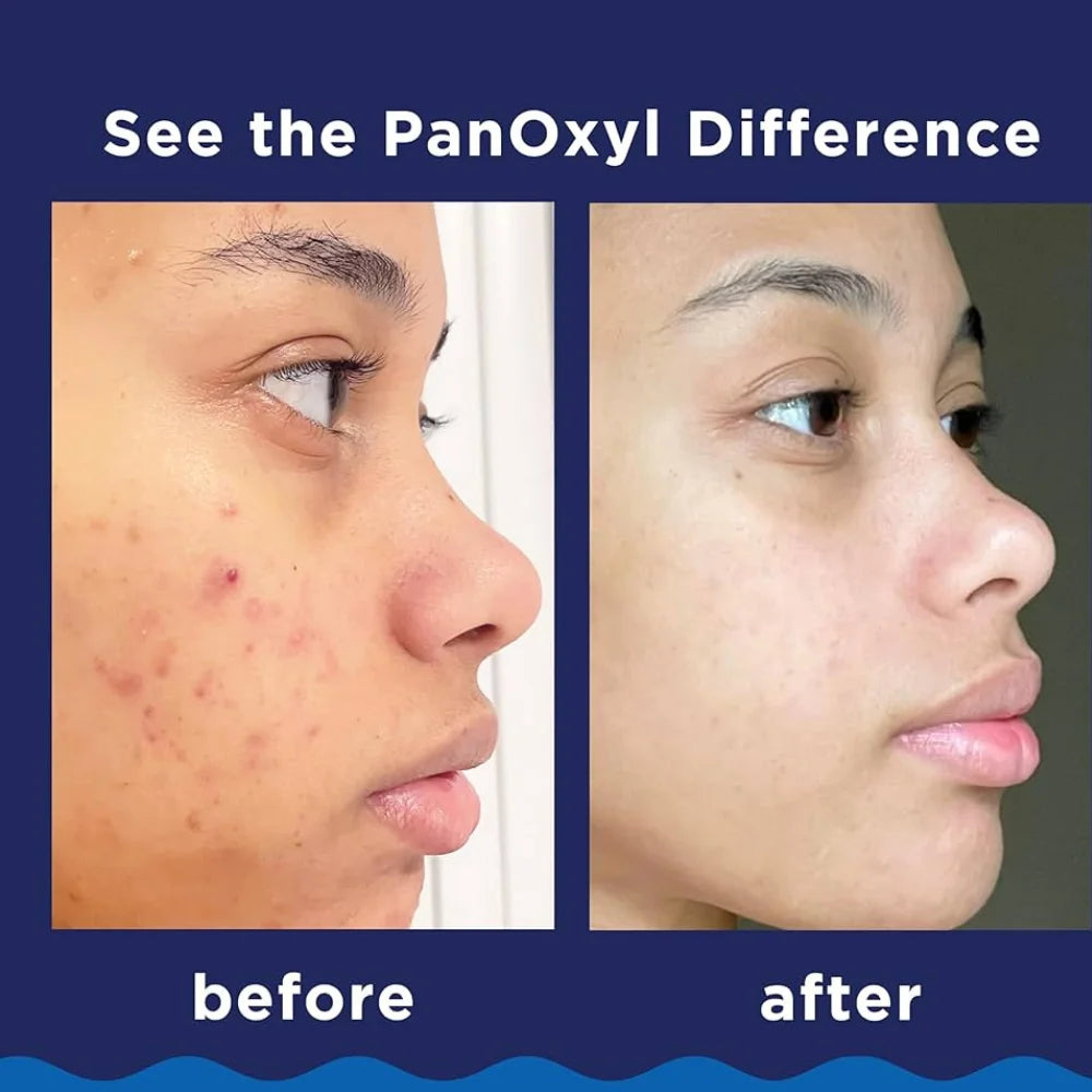 Acne treatment results: face before and after using foaming wash