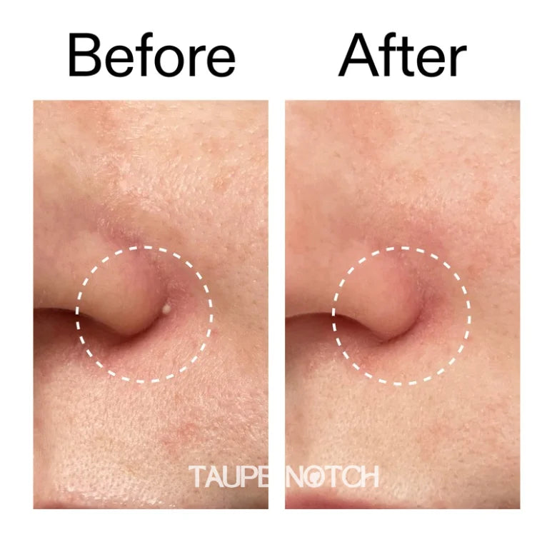 Clear round pimple patch on skin blemish, before-and-after comparison