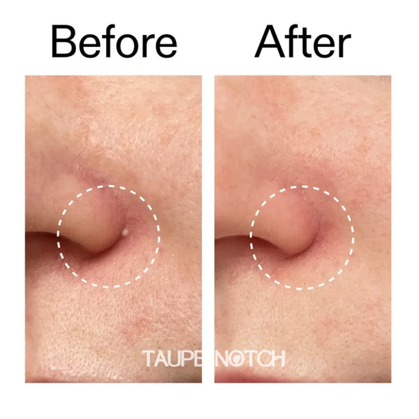 Clear round pimple patch on skin blemish, before-and-after comparison