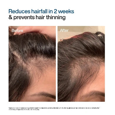 Before-and-after hair fall reduction comparison showing a close-up of a person's scalp and hairline, with text at the top reading 'Reduces hairfall in 2 weeks & prevents hair thinning'.